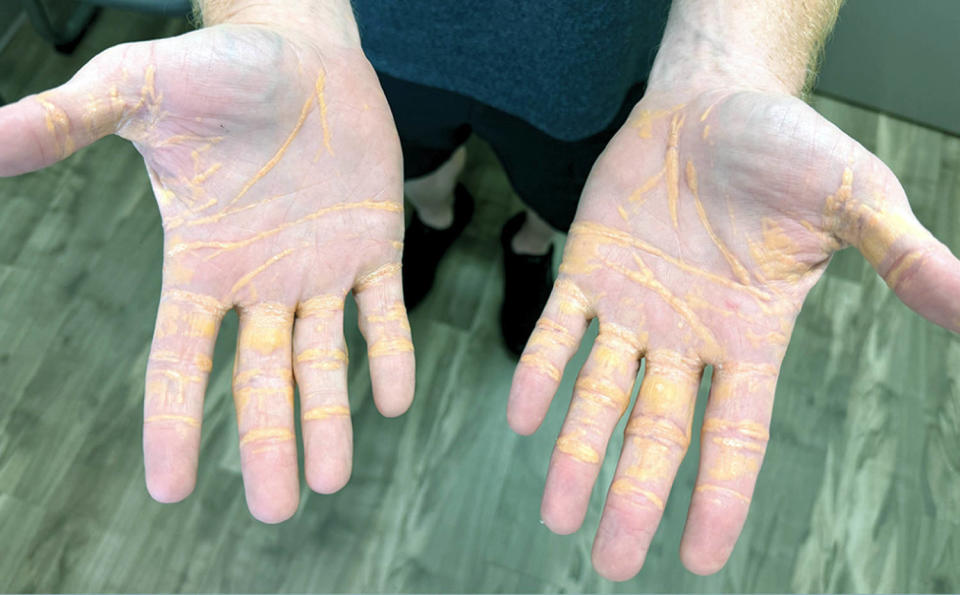 Hands of cholesterol (JAMA Network Course / American Medical Association)
