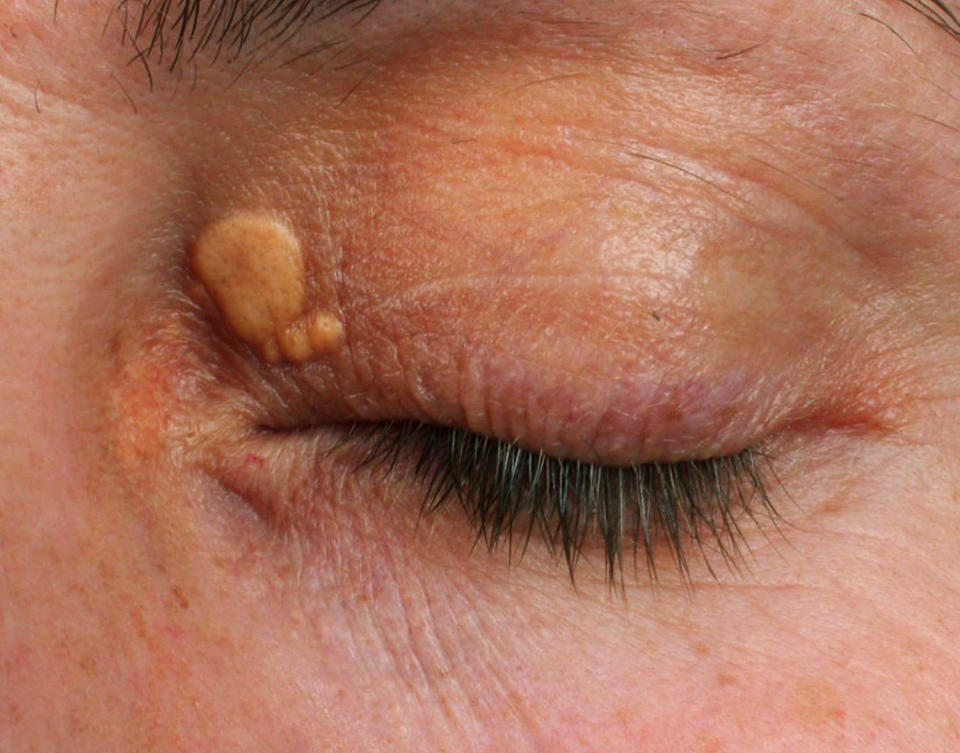 Cholesterol and eye deposits (Getty Earth)