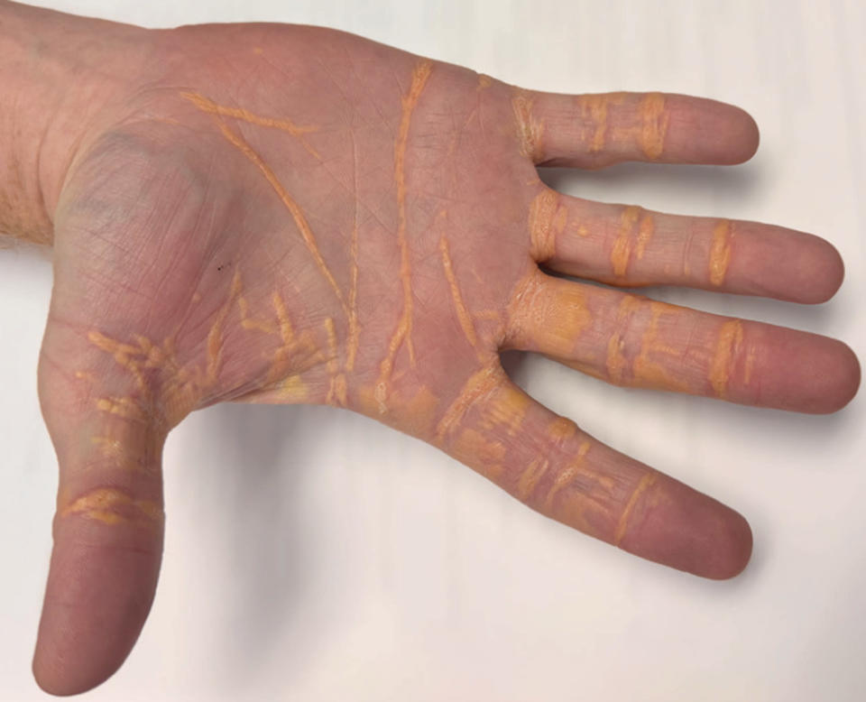 Hands of cholesterol (JAMA Network Course / American Medical Association)