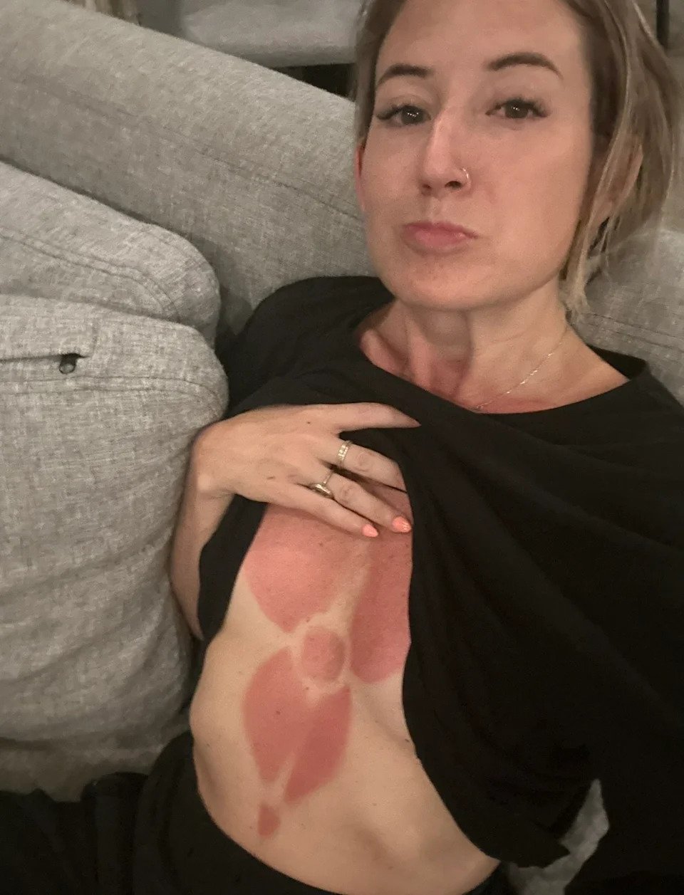 Lindsey Hall shows off the sunburn she got in Colombia. 